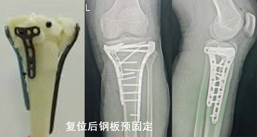 根据术前患者的ct,3d打印出原始受伤的胫骨平台骨折模型以及理想解剖