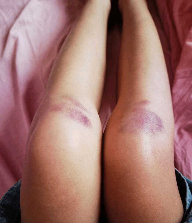 女朋友说骑自行车不小心把腿摔了,我看着她发来的照片,感觉应该会