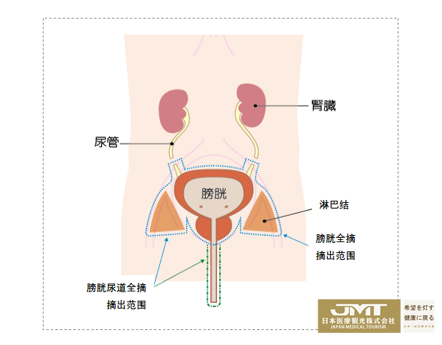 jmt癌症治疗-日本膀胱癌治疗有哪些要点?值得收藏!