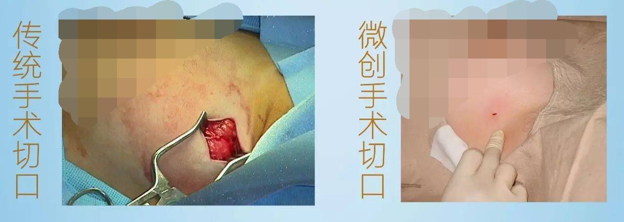 南阳医专一附院普通外科二病区率先开展" 乳腺肿瘤微创旋切手术".