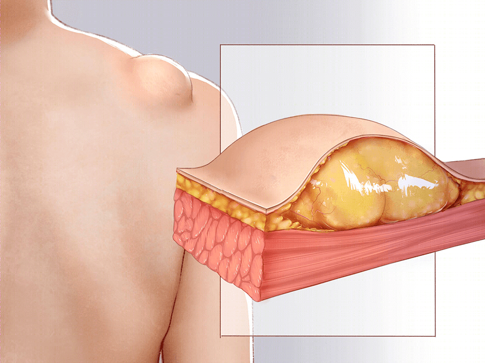 脂肪瘤是什么?会癌变吗