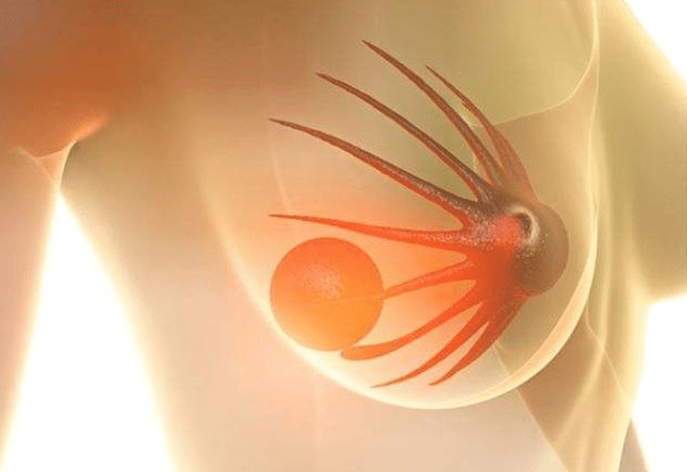 女性杀手乳腺癌早期有信号除了无痛肿块还需留意4种异常