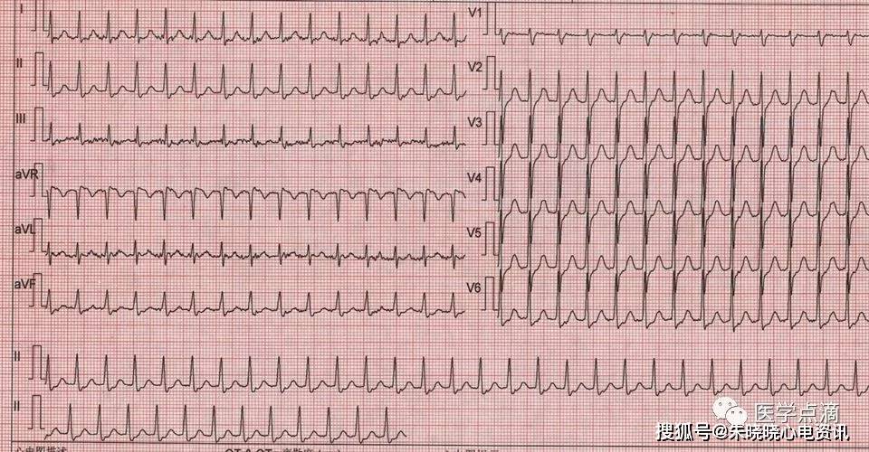 Ⅲ,avf导联上最好看)(250-350次/分)(v2,v3,avf,v1鉴别阵发性室上速)