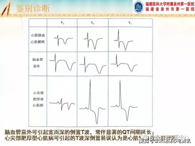 心肌缺血和心肌梗死的心电图改变ppt