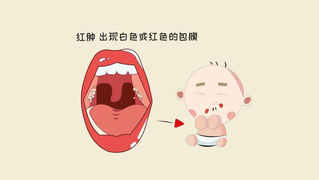 贵阳铭仁耳鼻喉医院:家长必看!儿童扁桃体炎在什么情况下需切除?