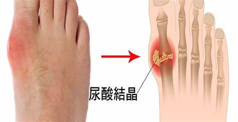 为什么你的痛风总是从脚开始痛起难道你还不知道是这个原因