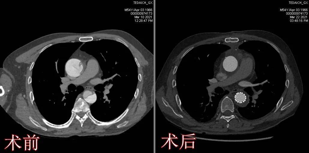 男子突发剧痛主动脉夹层随时索命泰心医院精准拆弹奇迹般挽回患者生命