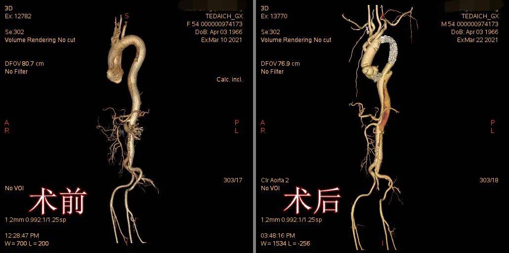 男子突发剧痛,主动脉夹层随时索命!泰心医院精准拆弹