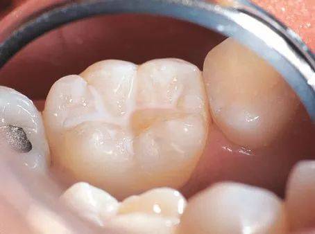 孩子牙痛怎么回事?是蛀牙吗?