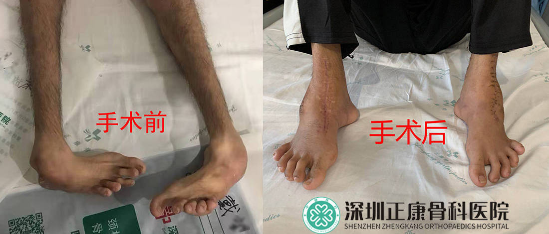 深圳小儿麻痹症拄拐杖30年,做矫形手术正常走路