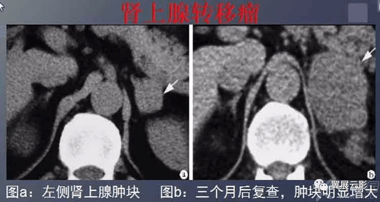 2,边缘结节状或小结节影,增大肾上腺密度尚正常.3,无明显形态学改