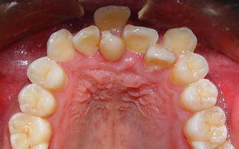 6.未能按时脱落,影响恒牙正常萌出的乳牙(乳牙滞留)