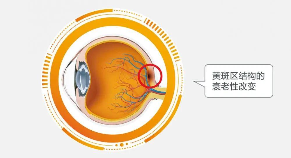 我眼睛里长黄斑了?