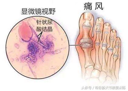 长沙洪山骨科王加升主任痛风性关节炎治疗不全面一不小心就会人财两失