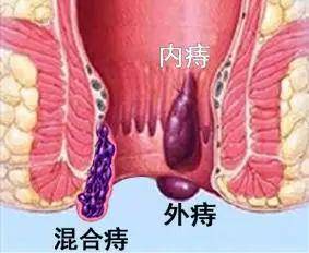 痔疮指人类肛门里,外长的小肉球,是肛周常见疾病,主要分为内痔,外痔