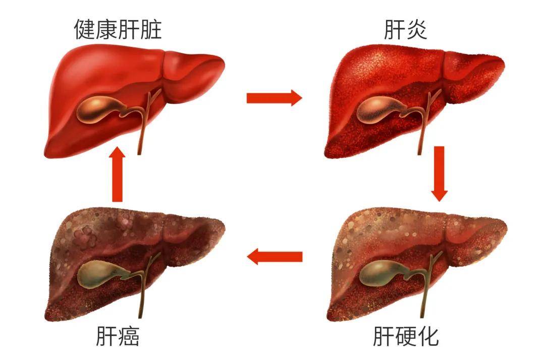 可发展为脂肪性肝炎→肝硬化→ 肝癌 脂肪肝是我国第二大肝病 我国的