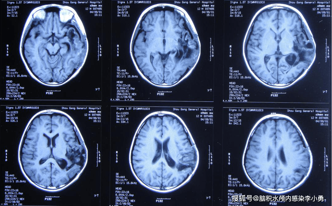 术后改变 开颅术后11年即2012年2月22日于当地新密县某医院复查头颅ct
