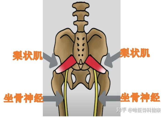 古神金为啥会在不知不觉的时候得了坐骨神经痛