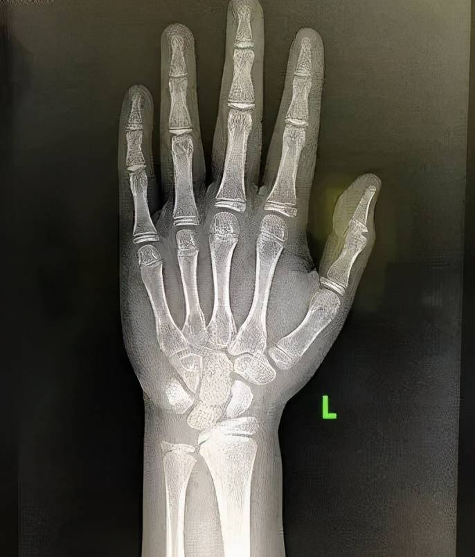 骨龄,即骨骼年龄,通常要拍摄儿童 左手手腕部的 x光片.