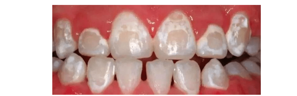 能使牙齿重新矿化