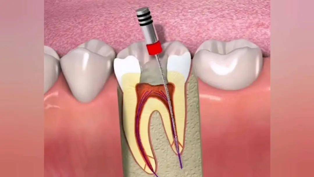 关于根管治疗的超全知识点_牙齿