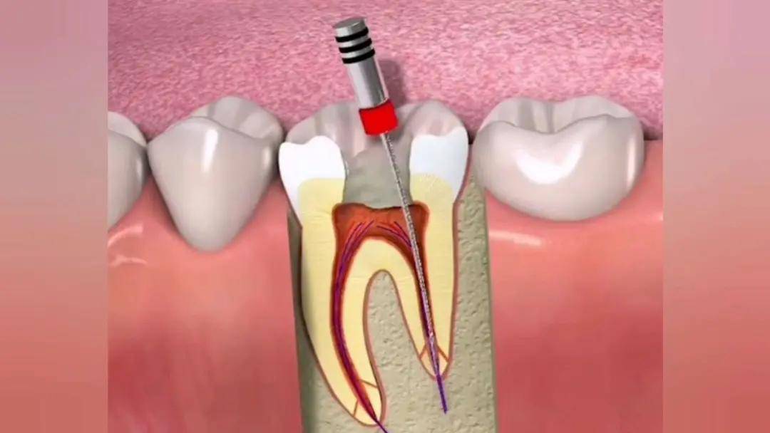 根管治疗也叫做"杀神经",将被龋坏的牙齿打
