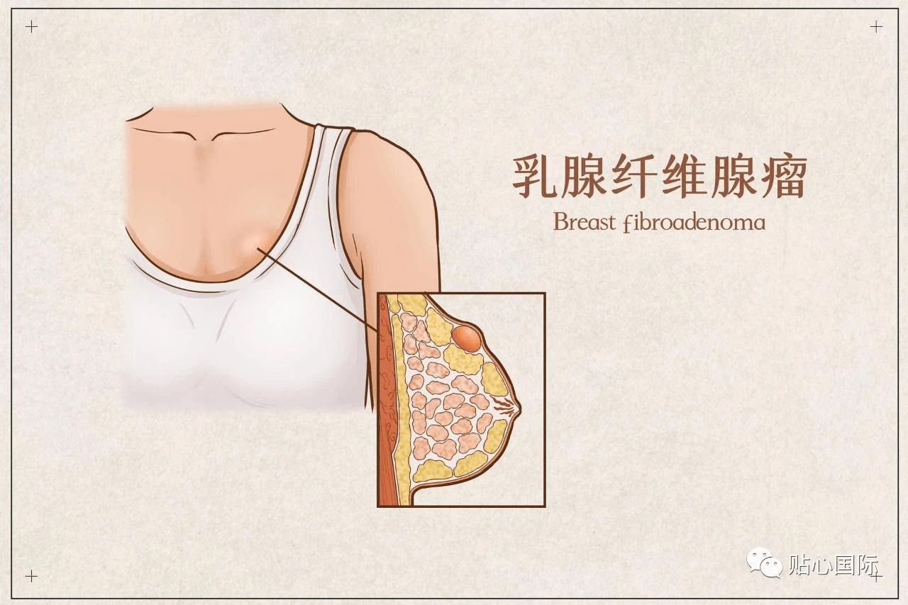 【贴心医生】乳房有肿块,就是乳腺癌吗?