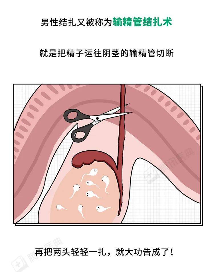 男性结扎还有没有精子?还能生育不