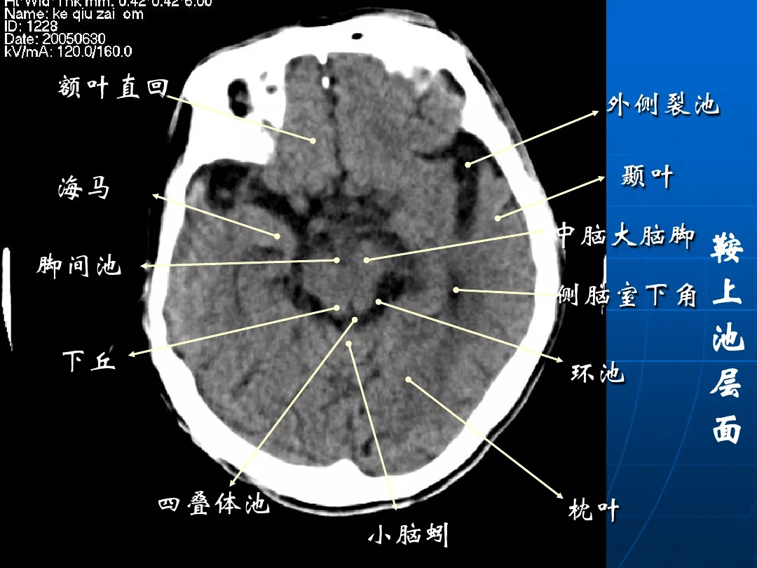 影像总结头颅ct基本知识与常见病变