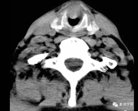 图3-5-15 声门下区癌ct平扫通过环状软骨层面见声门下区喉前壁局部软