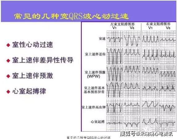 常见的致命心电图,临床医生必备!