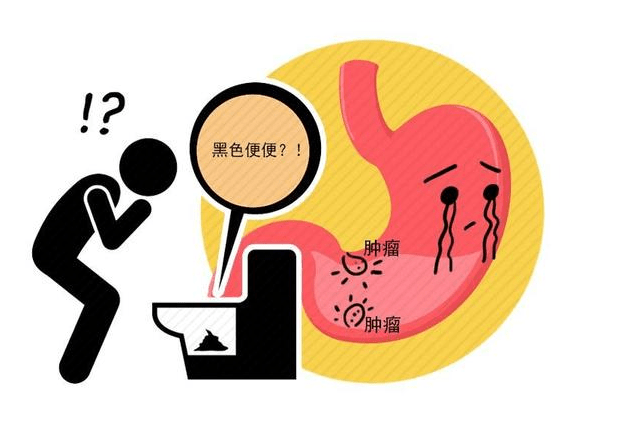 体内是否有癌,大便早就给出答案,这4个症状,希望你1个