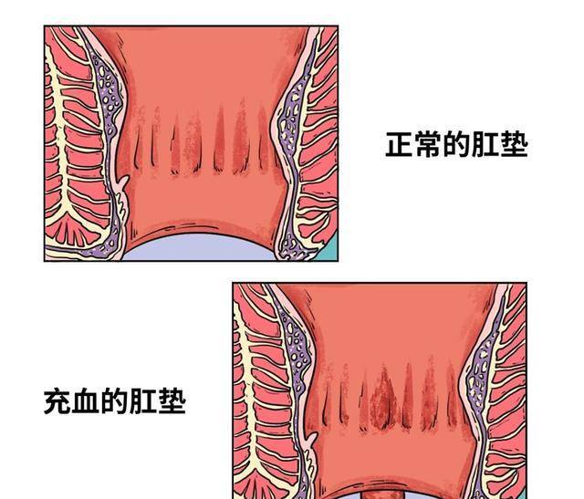 原创十人九痔,必须重视!4招助你远离痔疮,早知道屁股少遭罪