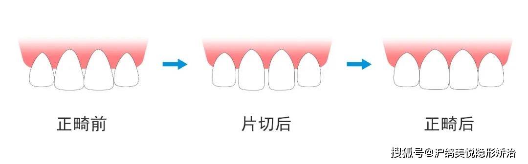 沪鸽美悦隐形矫治大课堂邻面去釉的秘密大公开