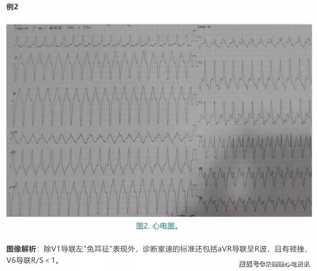 室性心动过速(室速)是一种常见的心律失常,易引起室扑,室颤,导致严重