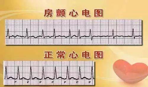 原创心脏跳乱了房颤发生,是快心率好?还是慢心率好?医生说明!