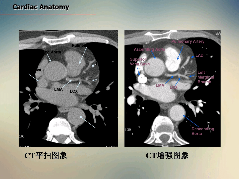 心脏ct断面解剖_平台