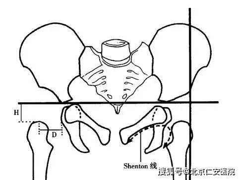 【髋关节常见疾病科普】小儿先天性髋关节脱位