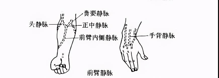 天使科普来了解一下静脉留置针的秘密吧