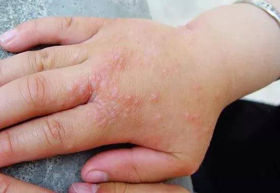 如果是小儿出现手上的水疱,就需要排除手足口病的可能.