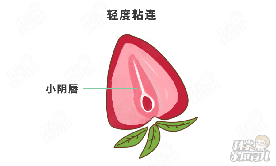 轻度粘连是小阴唇部分粘连,娃的阴道口或尿道口不能完全暴露.