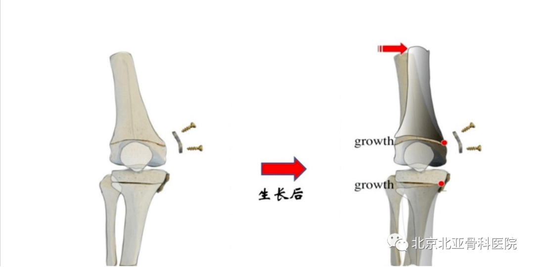 骨骺阻滞术是通过在骺板两侧施加压力限制其生长,未受力的对侧骺板