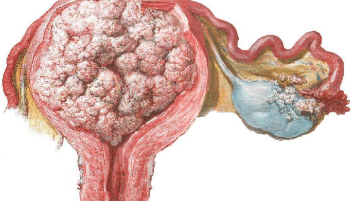 女性30岁后查出hpv,不必恐慌,或不用治疗,医生给您讲解