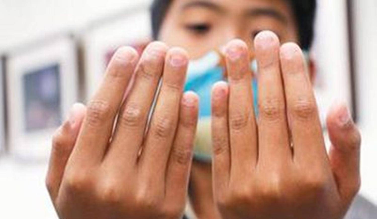 原创总忍不住咬指甲,到底是生病了还是正常现象?医生:这种行为得治