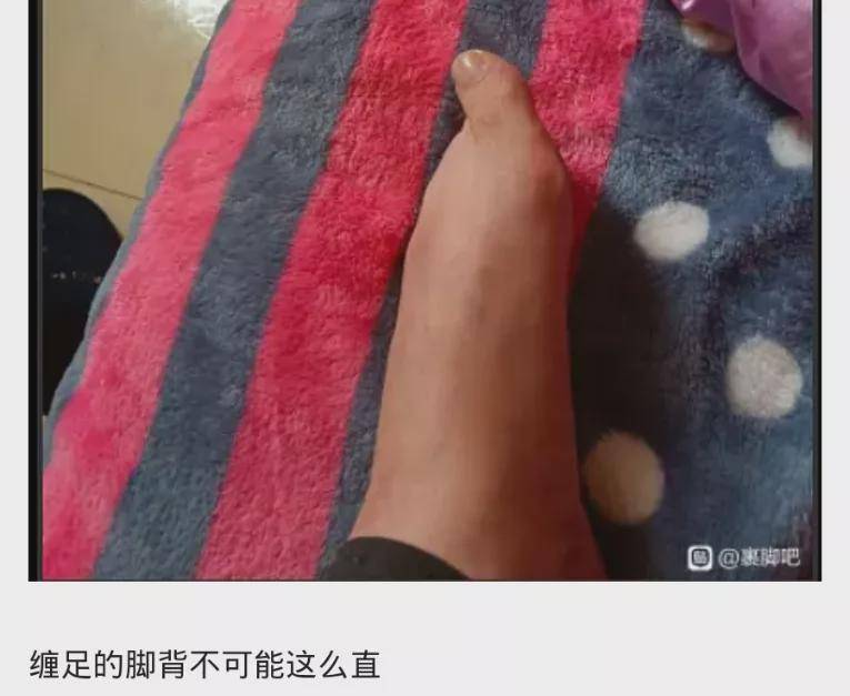 原创开刀瘦腿,断骨增高后,网红界又出自残变美术,复辟缠足?