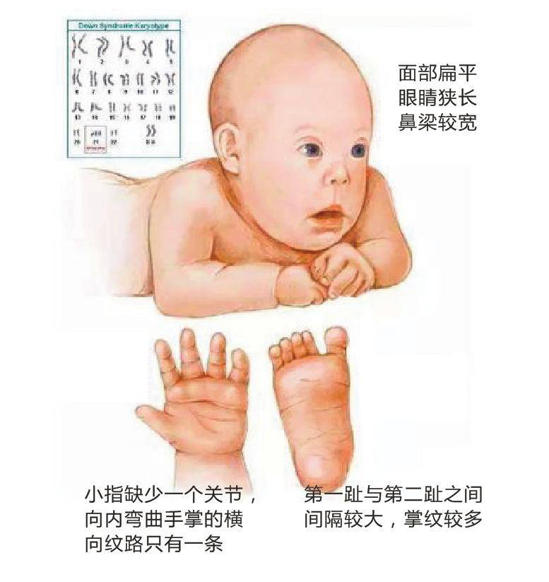 唐氏宝宝因比正常宝宝多了一条21号染色体,从而造成面容特殊,精神运动