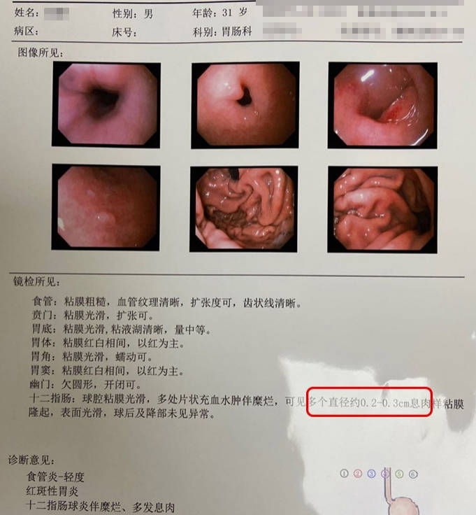 【真实案例】年轻小伙胃胀,打嗝拖延不治,一查竟发现多个息肉