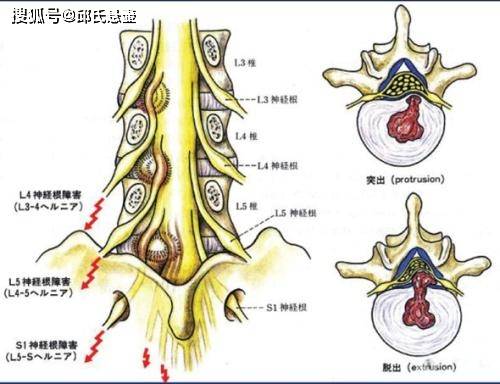 邱氏悬壶腰椎间盘突出坐骨神经痛是怎么回事