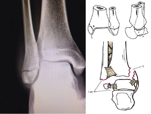 踝关节骨折的lauge-hansen分型