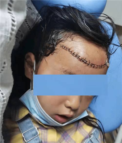 青岛"蜈蚣额头案"教训深刻,中小学生暑期人身安全应警钟长鸣